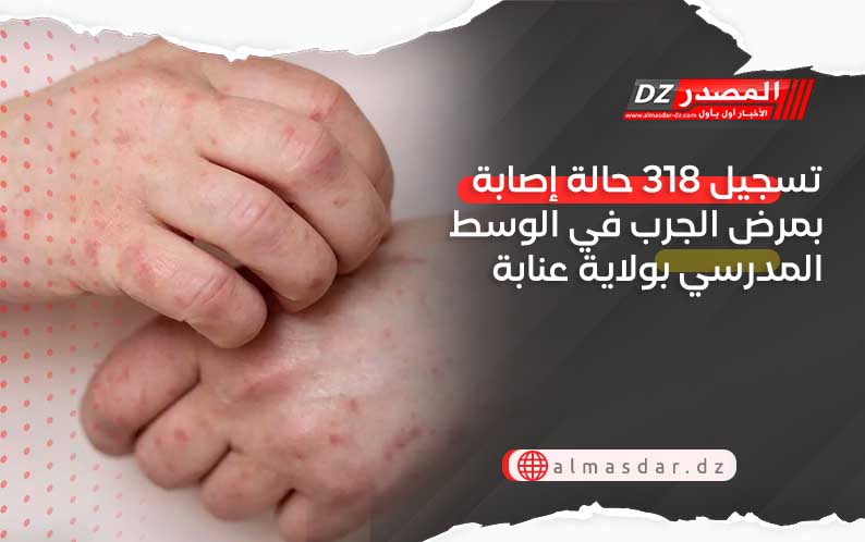 تسجيل 318 حالة إصابة بمرض الجرب في الوسط المدرسي بولاية عنابة