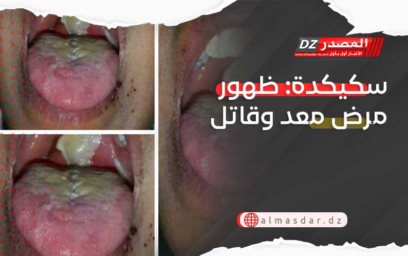 سكيكدة: ظهور مرض معد وقاتل
