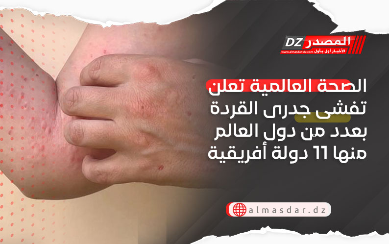 الصحة العالمية تعلن تفشى جدرى القردة بعدد من دول العالم منها 11 دولة أفريقية